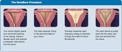 endometrial bleeding, uterine bleeding, ablation, endometrial ablation, pelvic pain, ultrasound