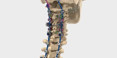 Cervical spinal fusion