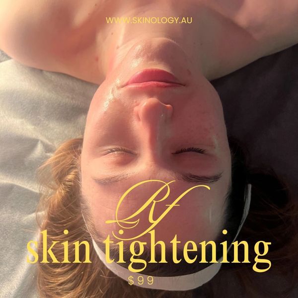 rf skin tightening treatment
