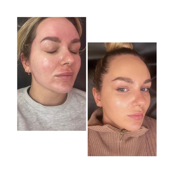 chemical peel results