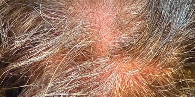 Hair Density Micropigmentation
