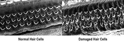 Magnified images of the inner ear (hearing organ).
No hearing loss and Hearing Loss