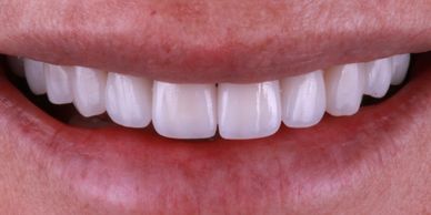 Smile design
Veneers