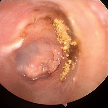 Endoscopic view showing inflammation and yellow deposits.