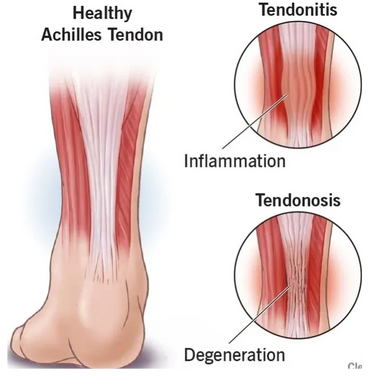 Image showing a healthy Achilles tendon, one with tendinitis and one with tendonosis 
