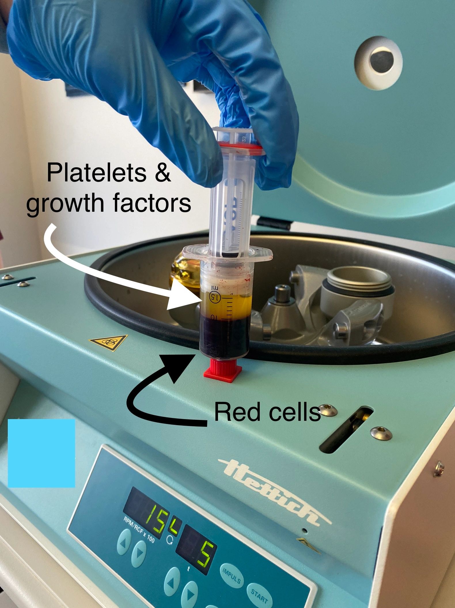 Prp Injection Knee, Prp, Stem Cells - Revive Spine and Pain Care