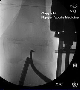 Femoral guide to accurately localize the best ACL tunnel location
