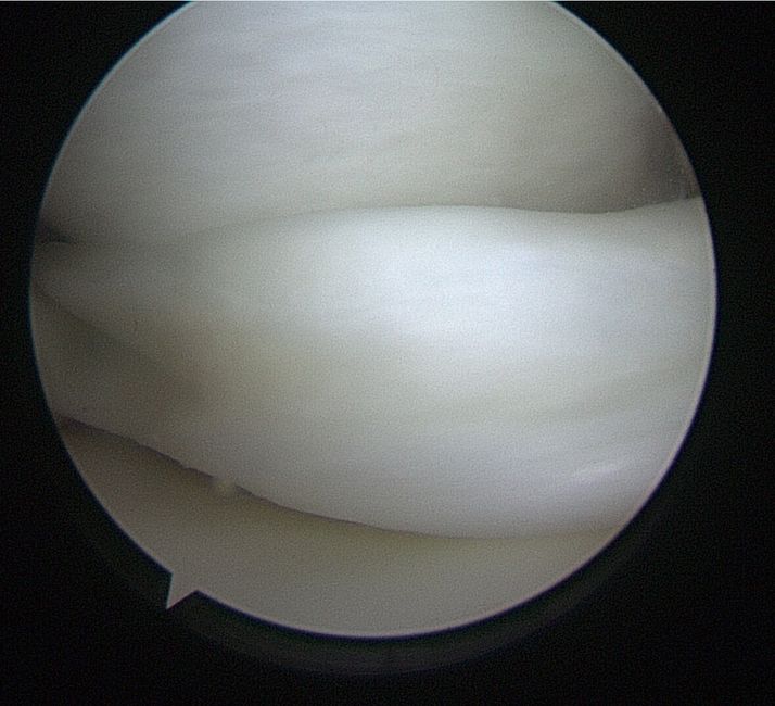 Meniscus Surgery Nguyen Sports Medicine