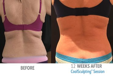 Before and After Coolsculpting Patient 