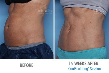 Before and After Coolsculpting Patient 