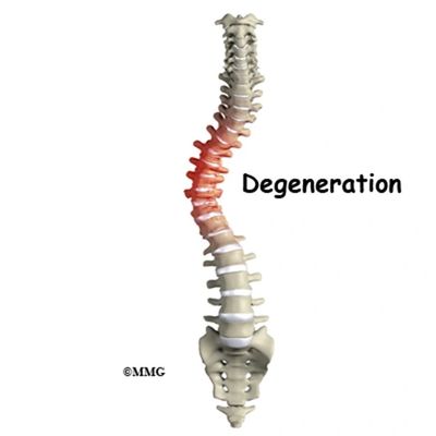 Adult scoliosis, degenerative scoliosis, de novo scoliosis, spine, pain, schroth method, exercises