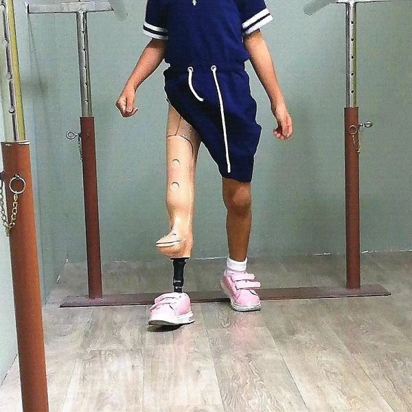 Child with prosthetic leg learning to walk.