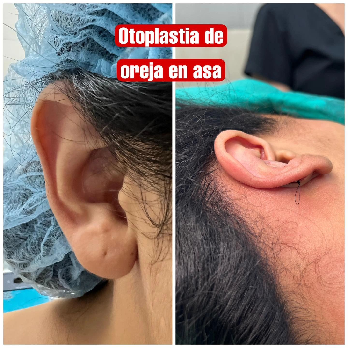otoplastia, oreja en Asa, orejas prominentes, cirujano plastico, managua, nicaragua