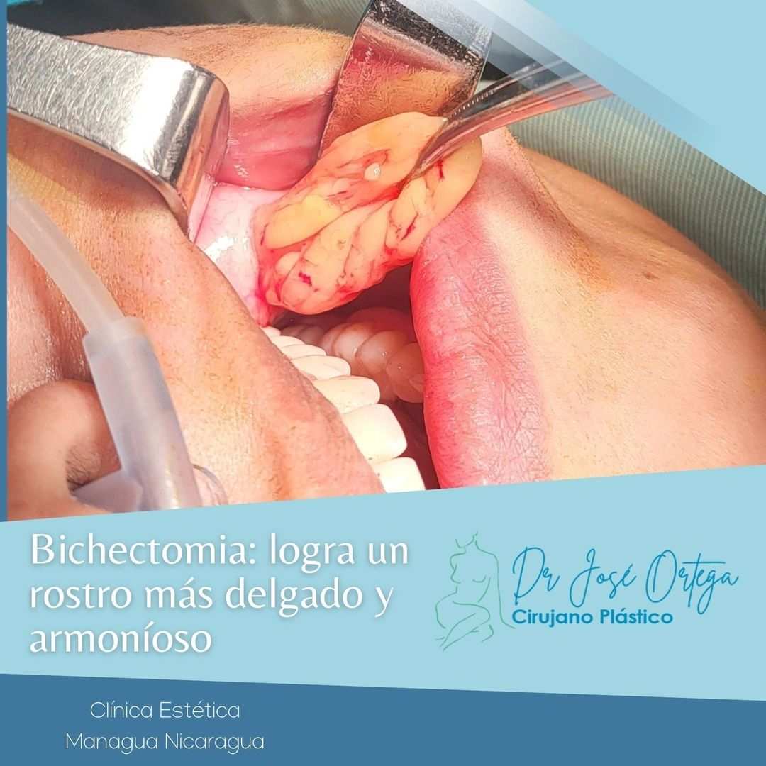 bichectomia, lipo papada , cirujano plastico, managua, nicaragua 