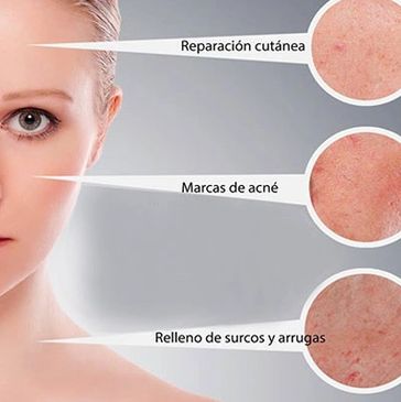 plasma rico en plaquetas
anti age
arrugas en la cara 
acné
dermo estética
cirugia plastica