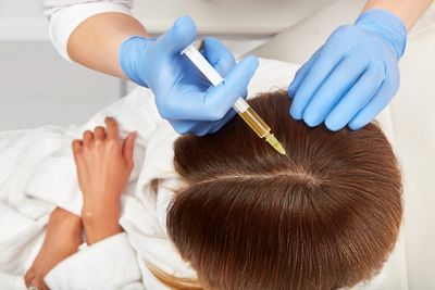 PRP for hair restoration 