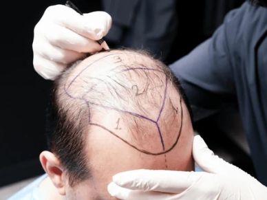 Doctor marking scalp for hair transplant.