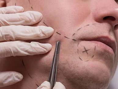 Marked face undergoing cosmetic procedure.
