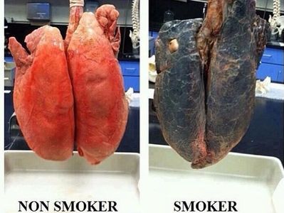After just 4 months after quitting smoking your lungs will have rid all the tar.We can help you Quit
