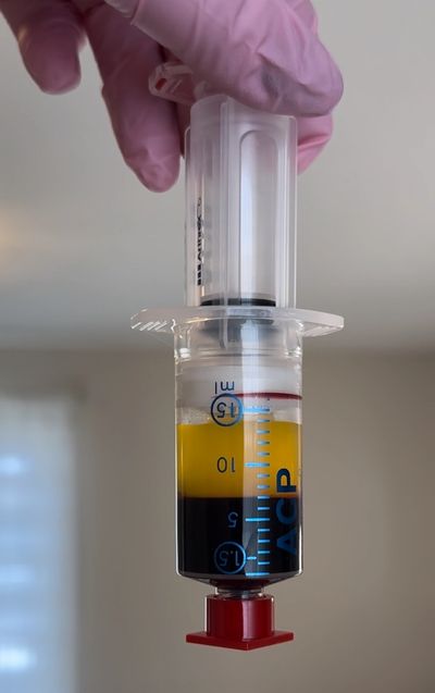Platelet Rich Fibrin