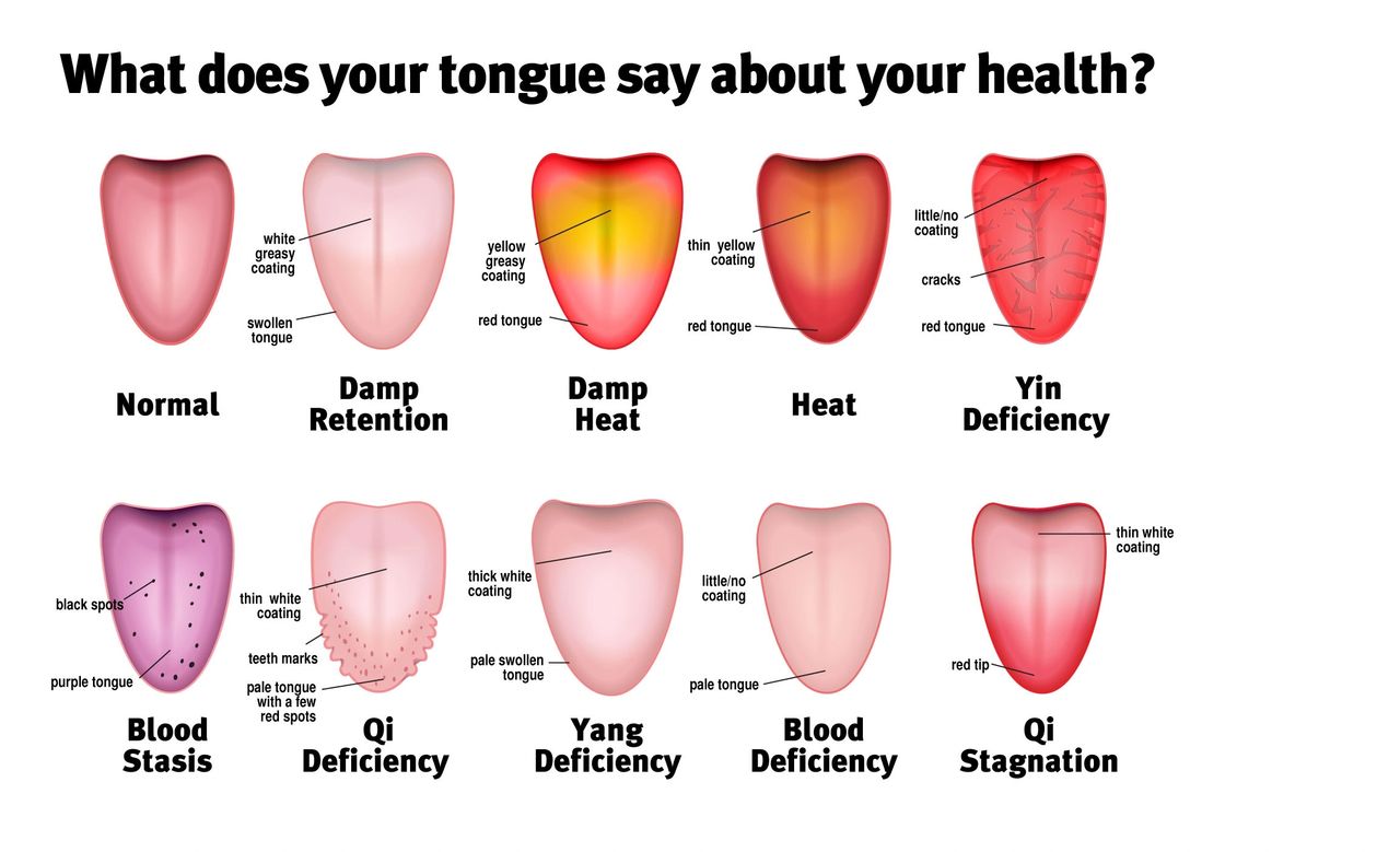 Tongue Says about your health 1