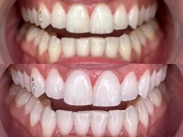 Professional teeth whitening 