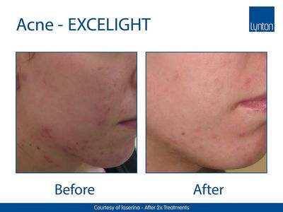 Lynton Excelight Acne Results, showing a significant reduction in spots/ redness after 2 treatment.