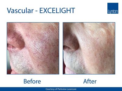 Lynton Execlight Vascular Lesions results. After picture shows the majority of lesions have gone.