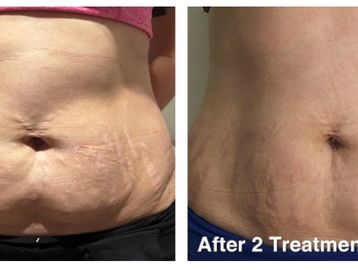 stomach after two cavitation treatments
