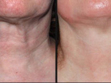 before and after neck firming
