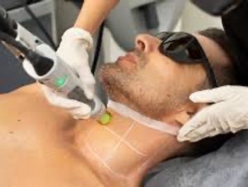 laser hair removal on a mans neck