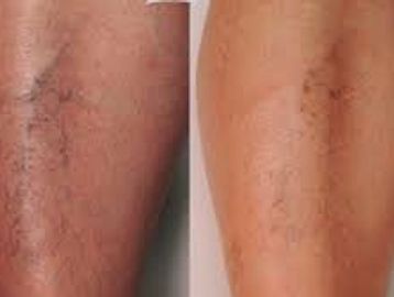 spider veins on legs