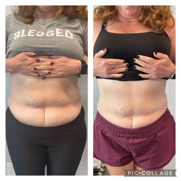 Non-Invasive Body Sculpting (2) 30 Minutes of HIFM+RF sessions
