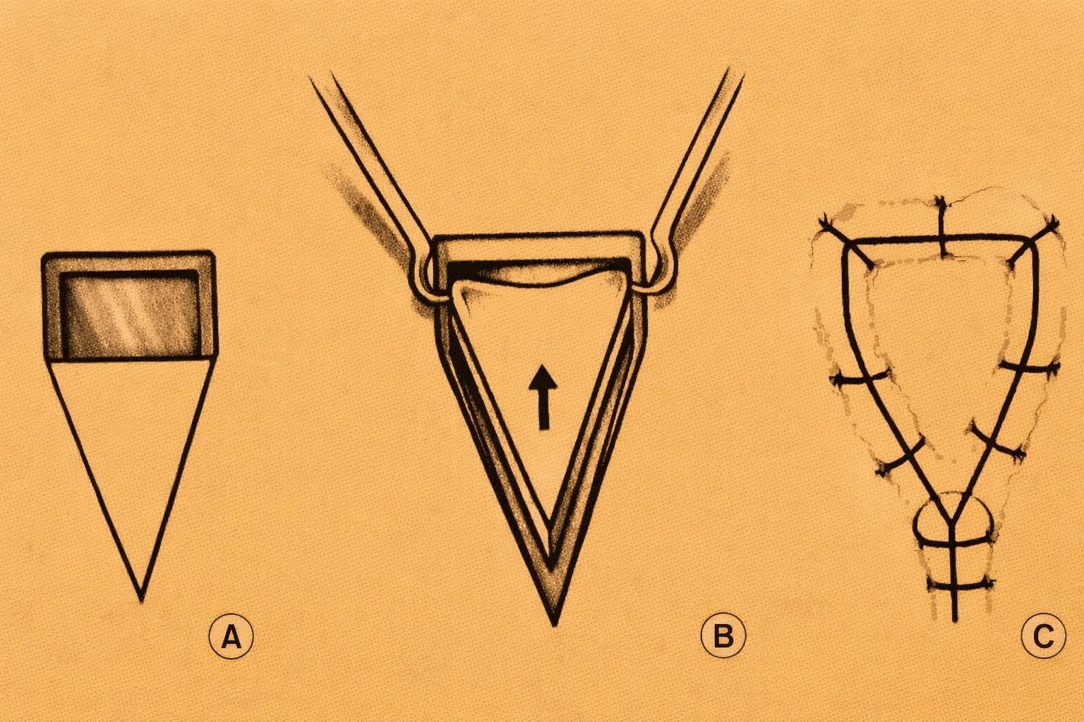Three-step surgical procedure diagram illustrating triangular flap creation and suturing.