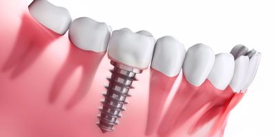 Dental Implants