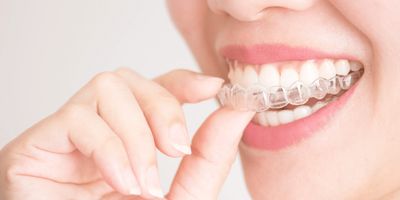 Dental Aligners