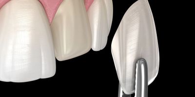 Dental Veneers