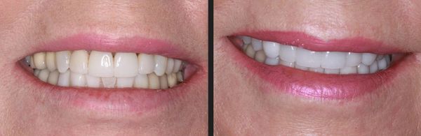 Comparison of teeth before and after whitening or dental treatment.