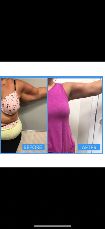 Armlift before and after