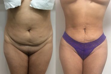Tummy tuck before and after
