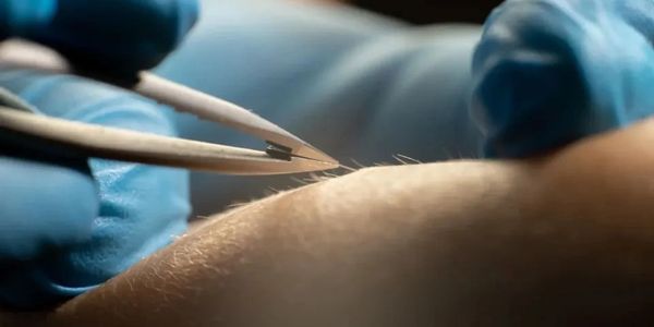Extraction d'un cheveu incarné avec une pince fine.