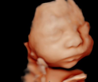 3D ultrasound image of a fetus showing facial features in detail.