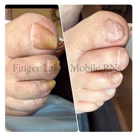 Before and after images of toenail care and cleaning.