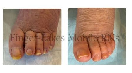 Comparison of toenails before and after treatment showing healthier nails.