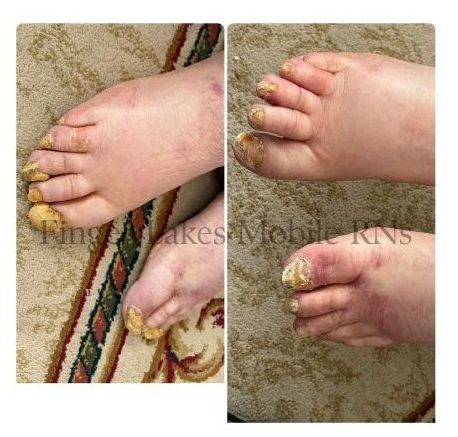 Feet with thick, discolored, and cracked toenails, possibly fungal infection.