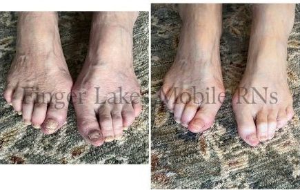 Before and after photos showing foot care improvement on elderly feet.