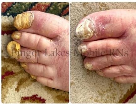 Close-up of feet with severely thickened, yellow toenails on a carpet.