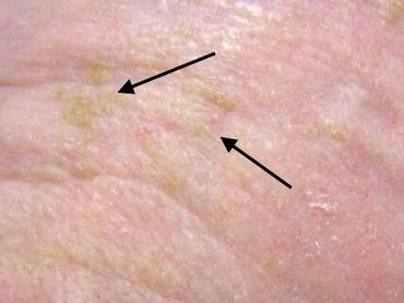 Actinic Keratosis