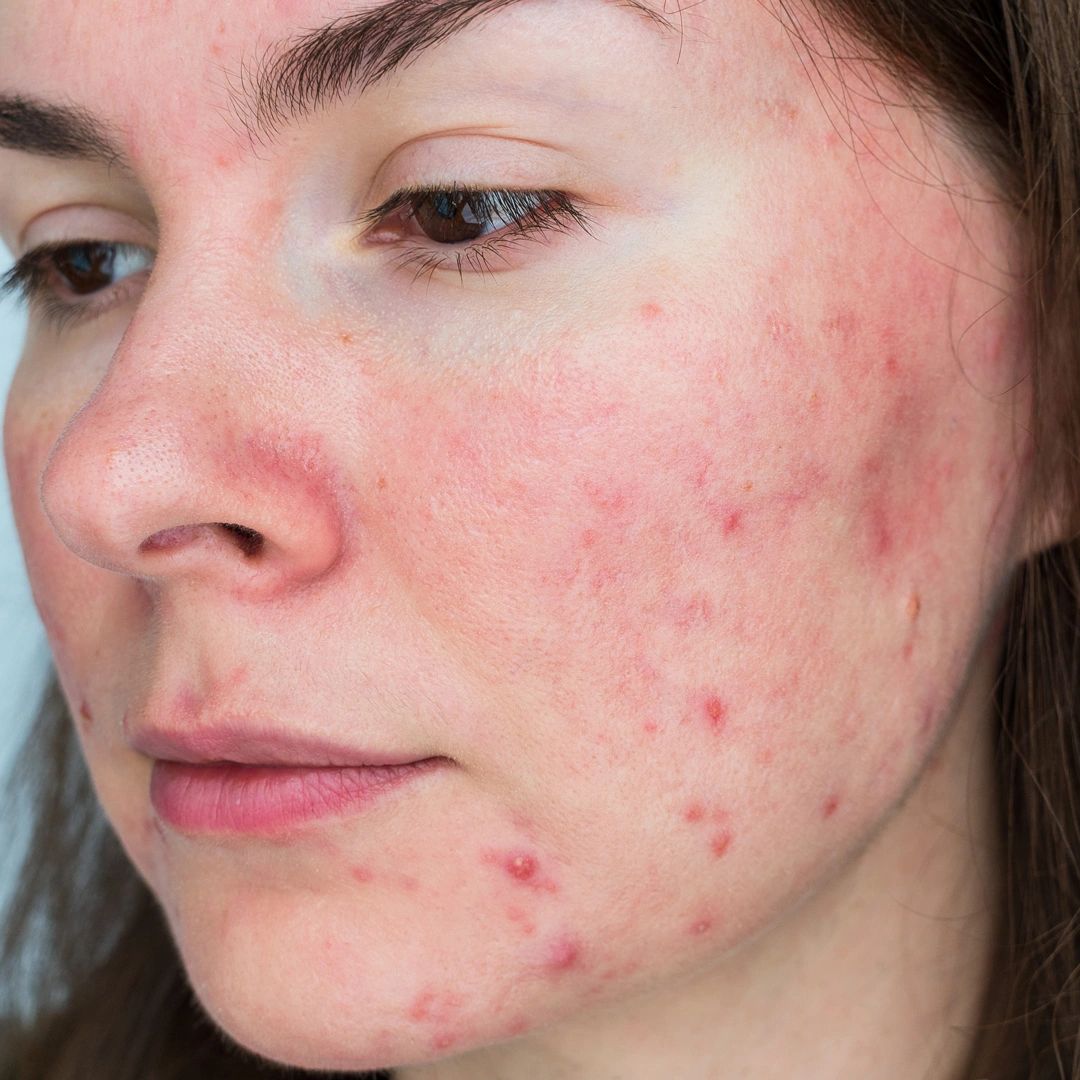 How do breakouts occur and what to do about them?