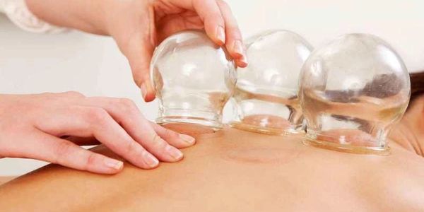 #Cupping therapy